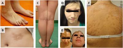 Genetic Signatures From RNA Sequencing of Pediatric Localized Scleroderma Skin